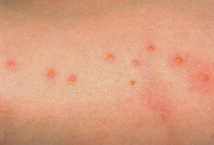 bed-bug-bites-doctor-in-one-hour-to-you-24-hours-a-day-7-days-a-week-call-1-855-222-0040